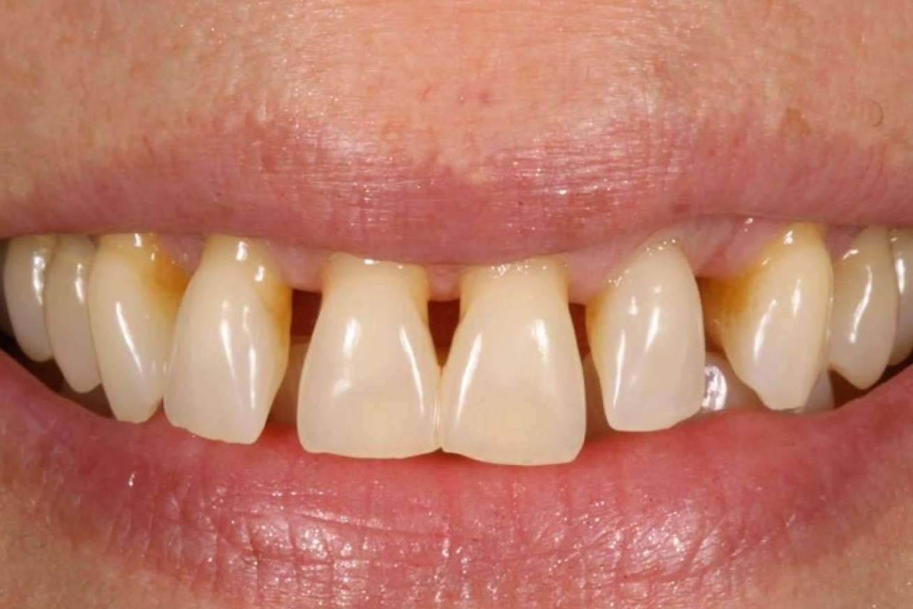 La Clínica Dental Ruiz de Gopegui explica cómo tratar la gingivitis