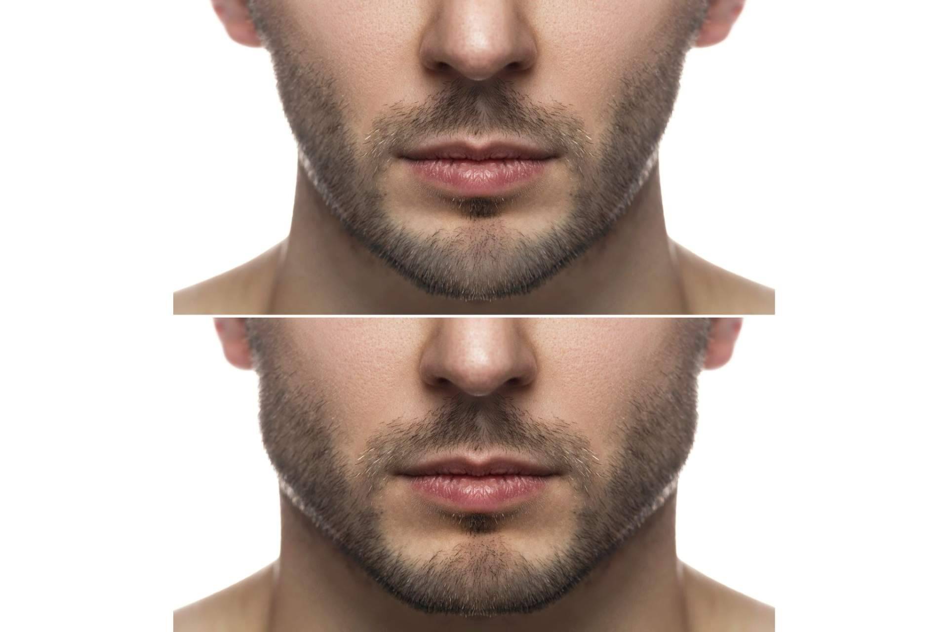Medicina estética masculina; tendencias emergentes y enfoques personalizados