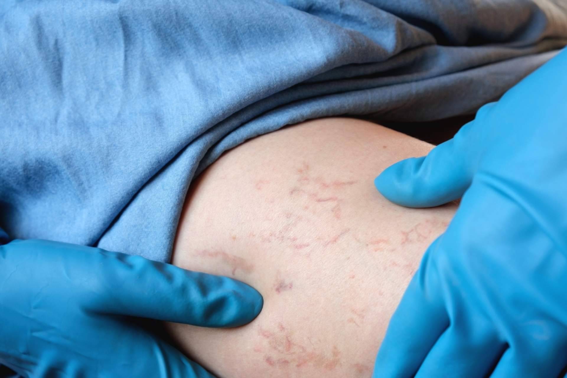 ¿Dónde encontrar especialistas en la eliminación de varices? Elegansse