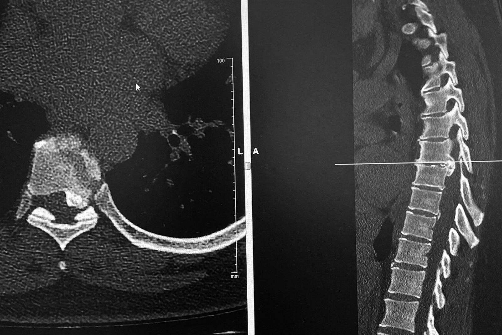 El neurocirujano Dr. Carlos Botella-Asunción es especialista en cirugía de hernia discal