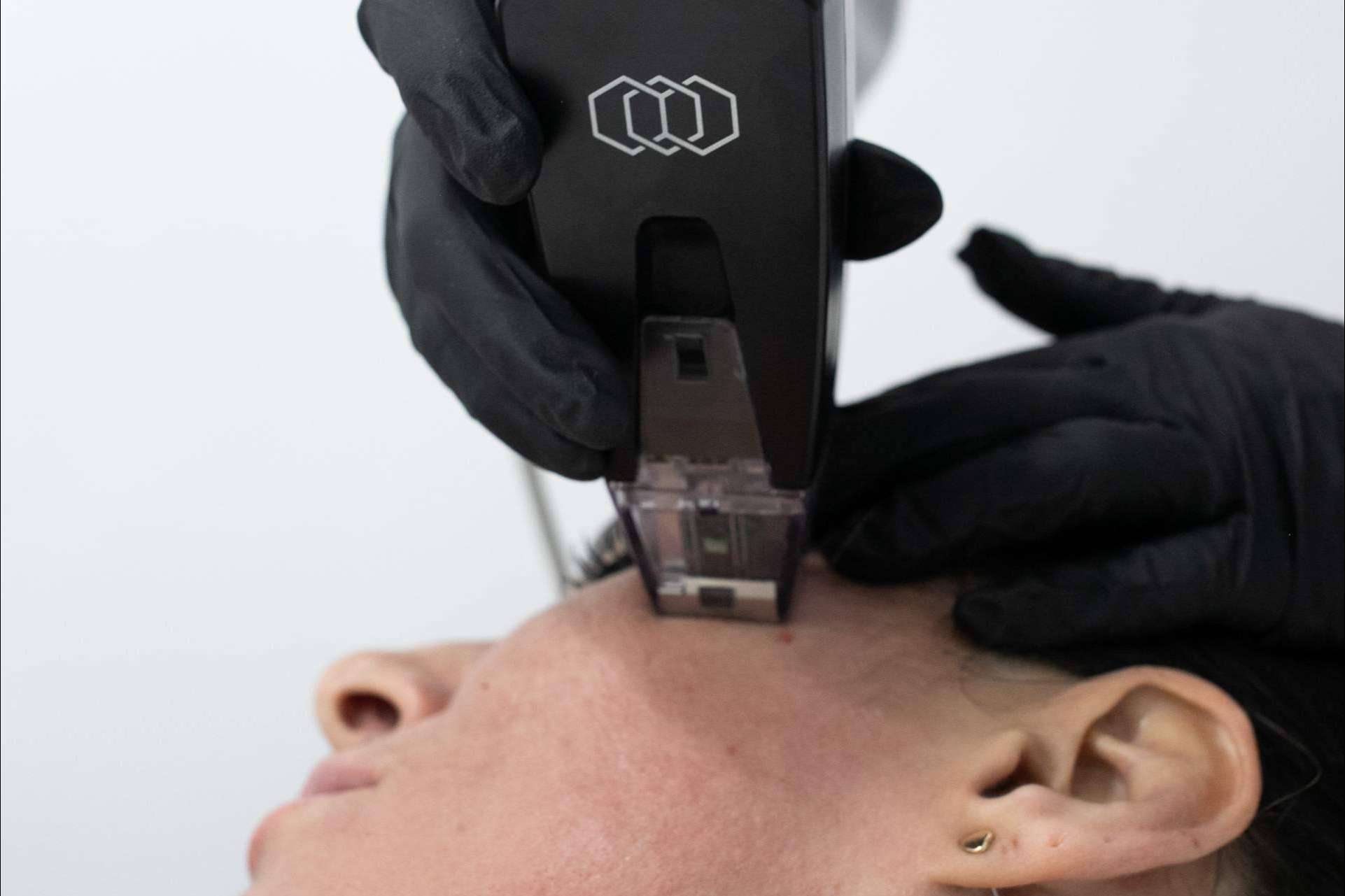 Tratamiento rejuvenecedor Morpheus8 Facial y Corporal, disponible en la Clínica BK