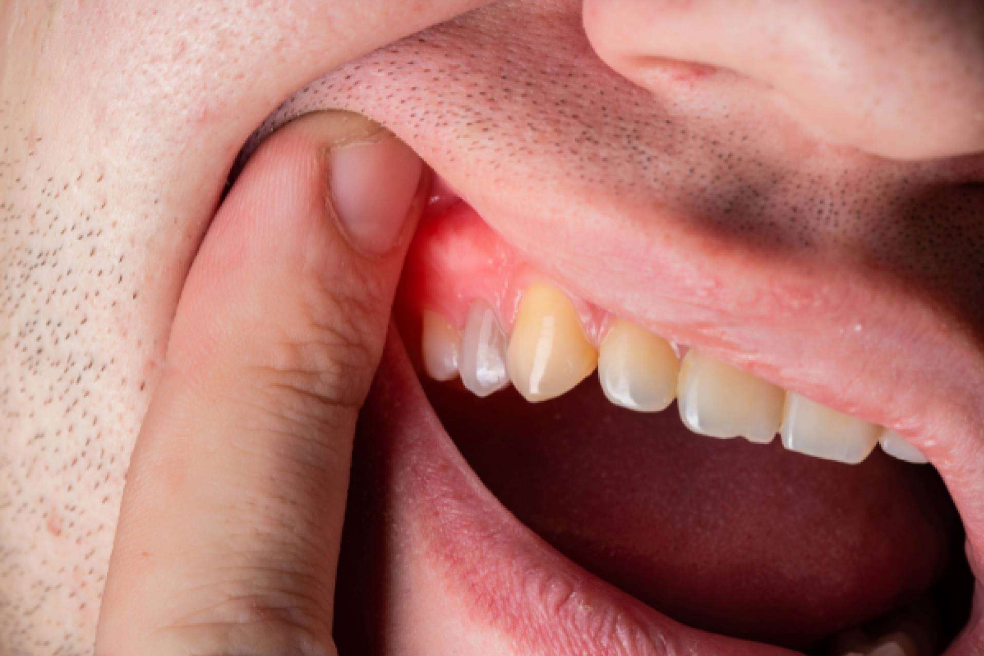 Prevención y tratamiento para diferentes enfermedades de las encías, con Denty Dent