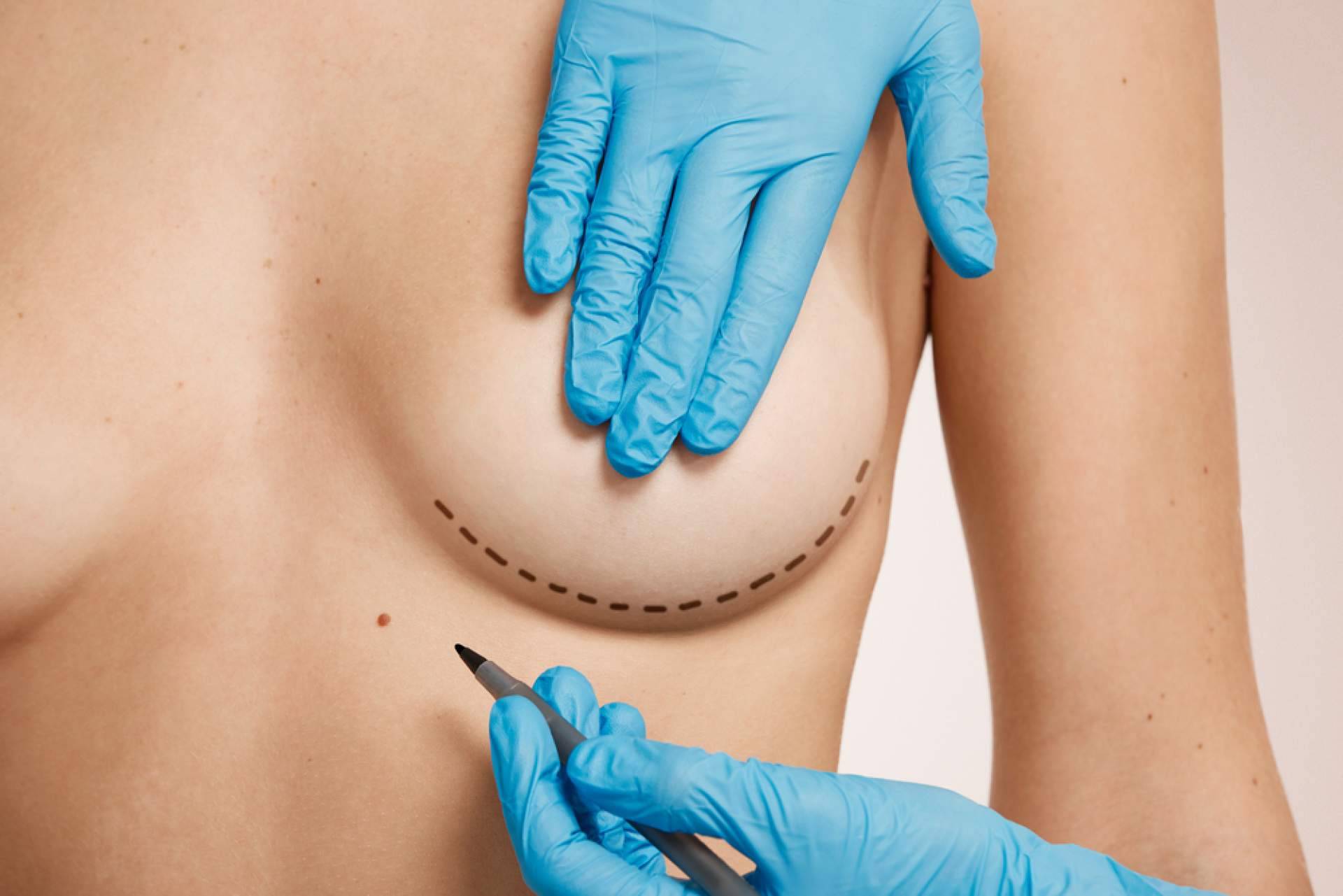 Clínicas Beauty&Beauty, un ejemplo a seguir en cuanto a corrección de mamas tuberosas