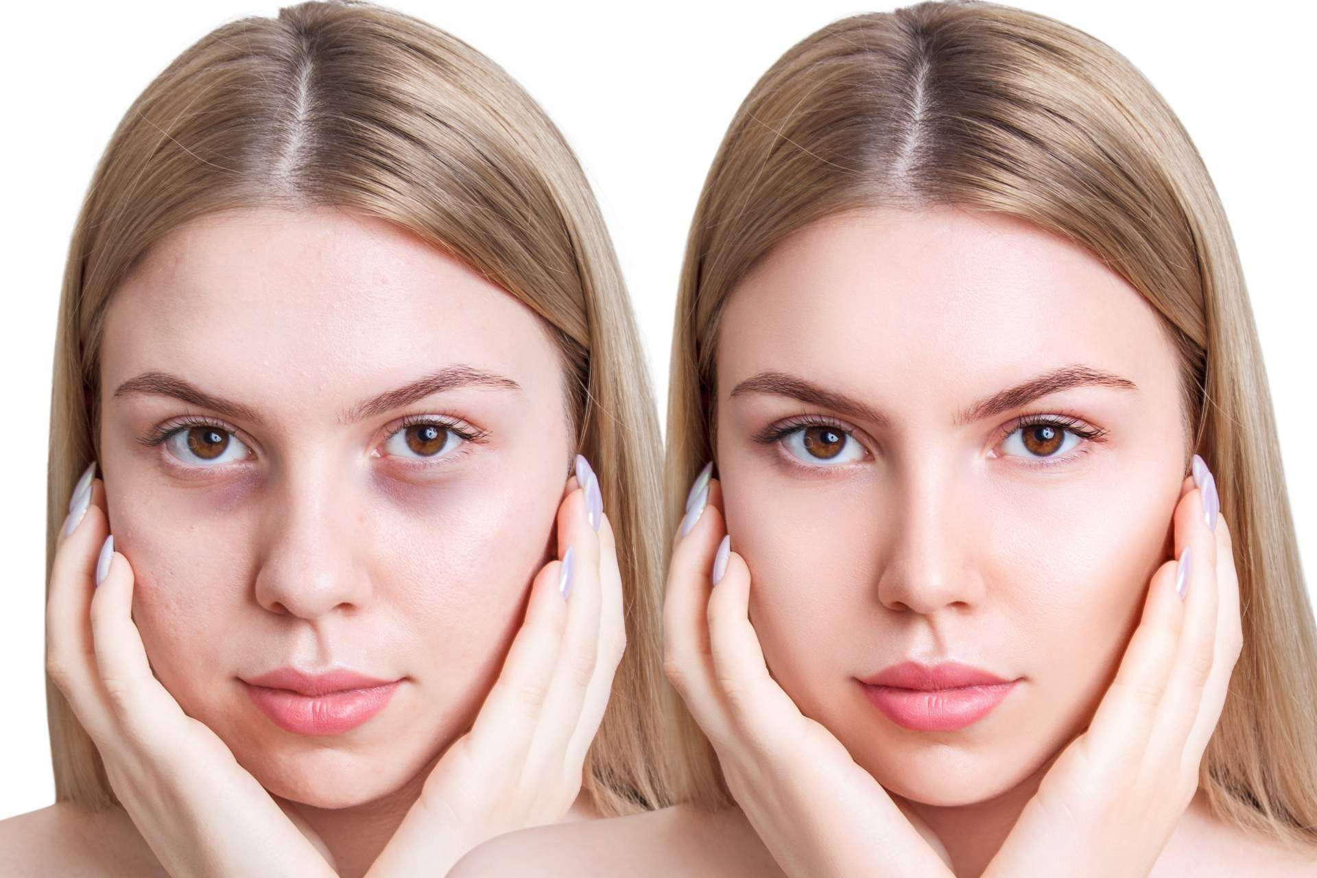 Centro Estética El Pilar ayuda a combatir las ojeras con el tratamiento no invasivo de ácido hialurónico