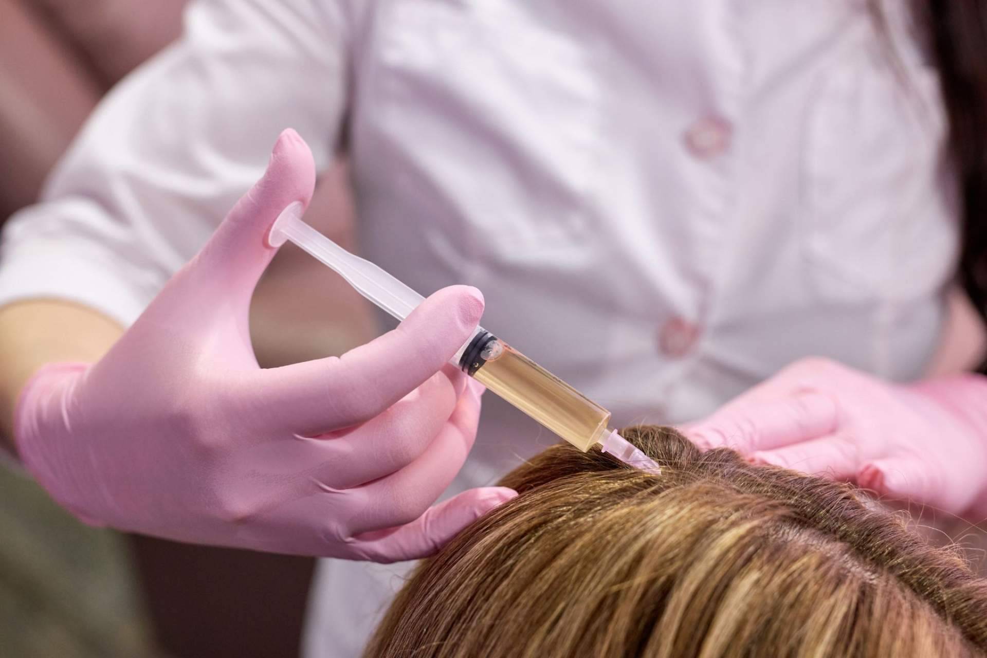 Mesoterapia capilar con fármacos desarrollada por el Doctor Aníbal Mora