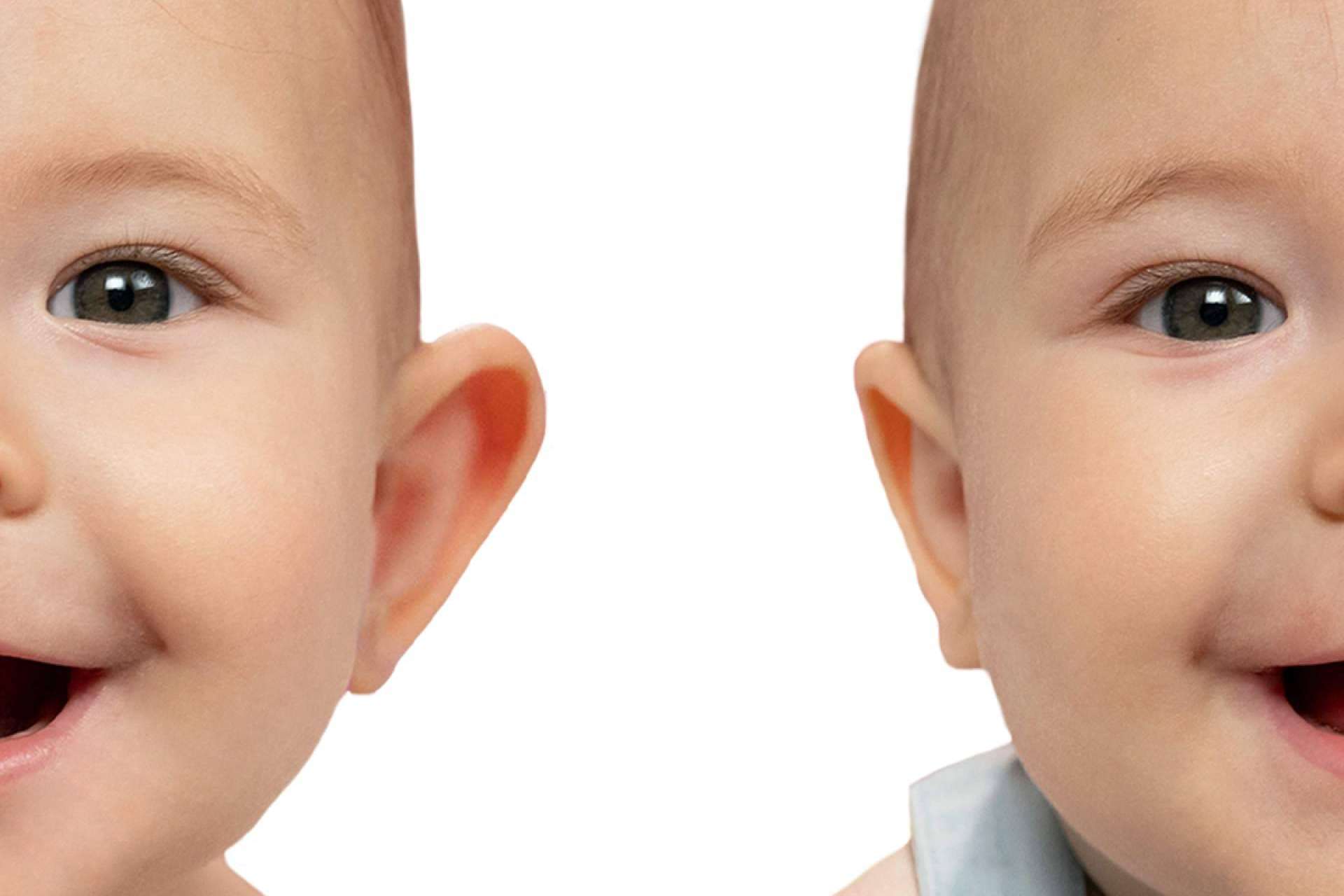 Otostick Bebé; el corrector de orejas de soplillo para bebés y niños fabricado íntegramente en España