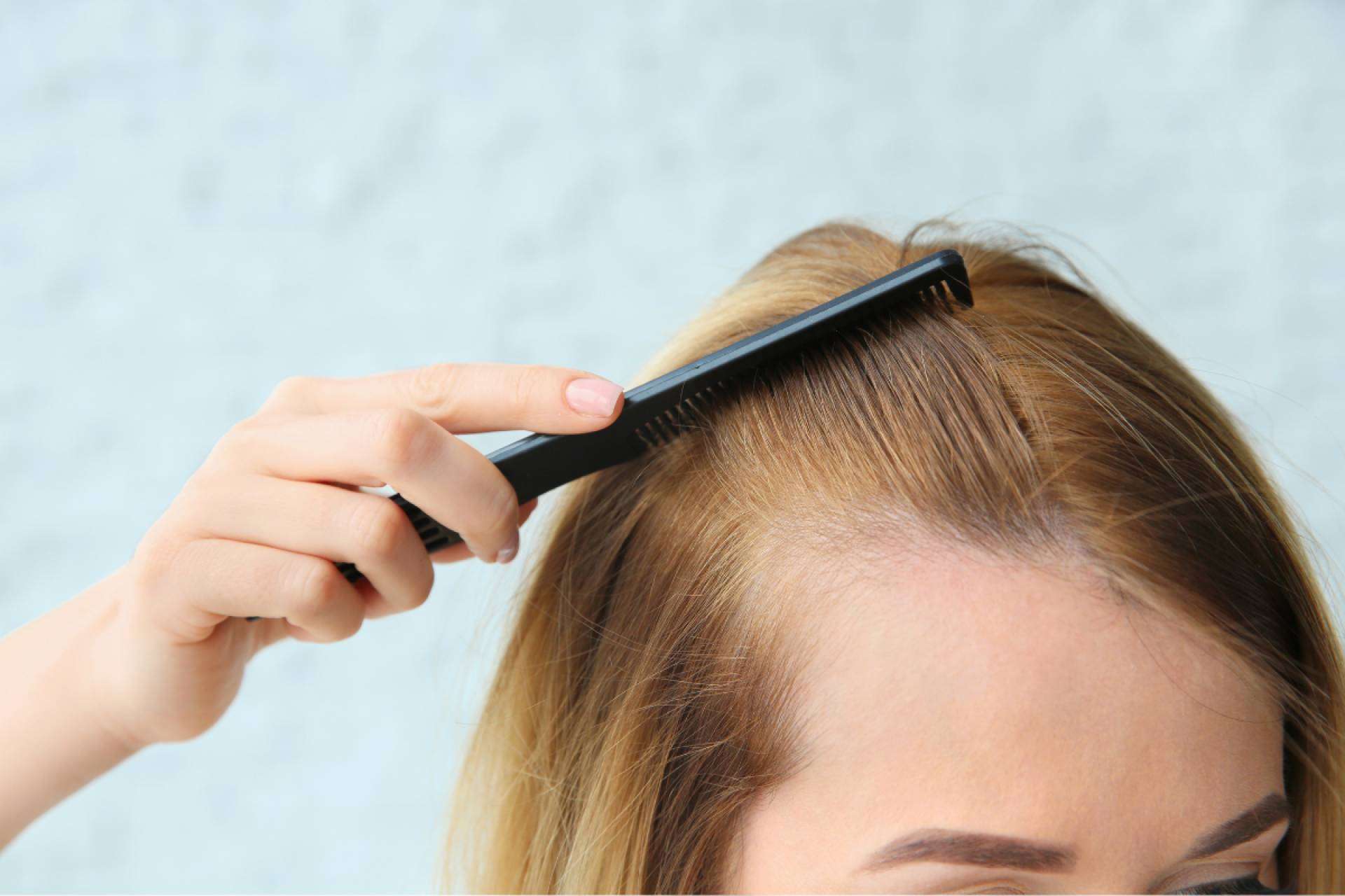 El Institut Mèdic DaVinci precisa los efectos de la alopecia androgénica en hombres y mujeres
