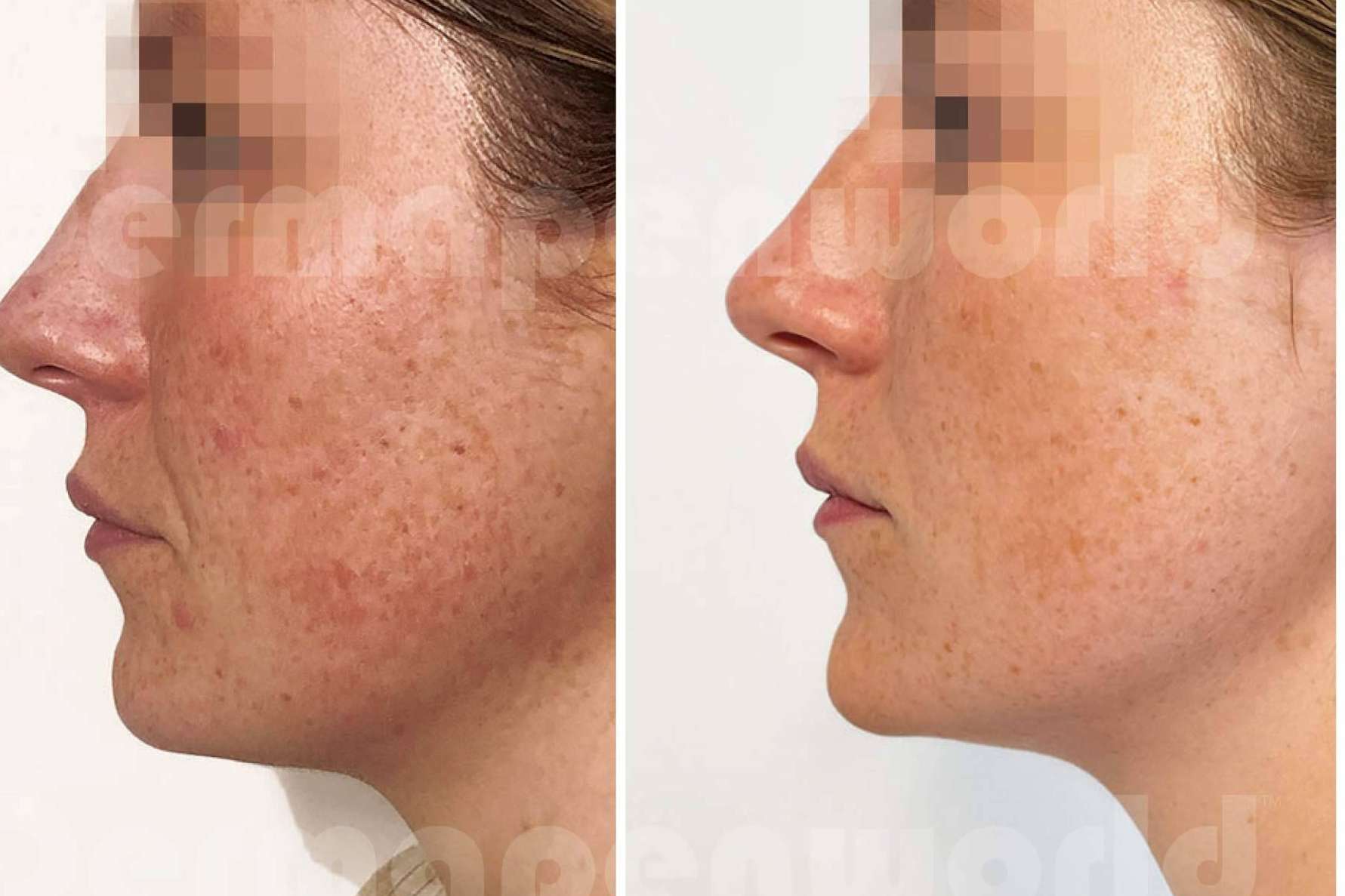 DERMAPEN&#x2122; de THR, es el microneedling médico estético por excelencia