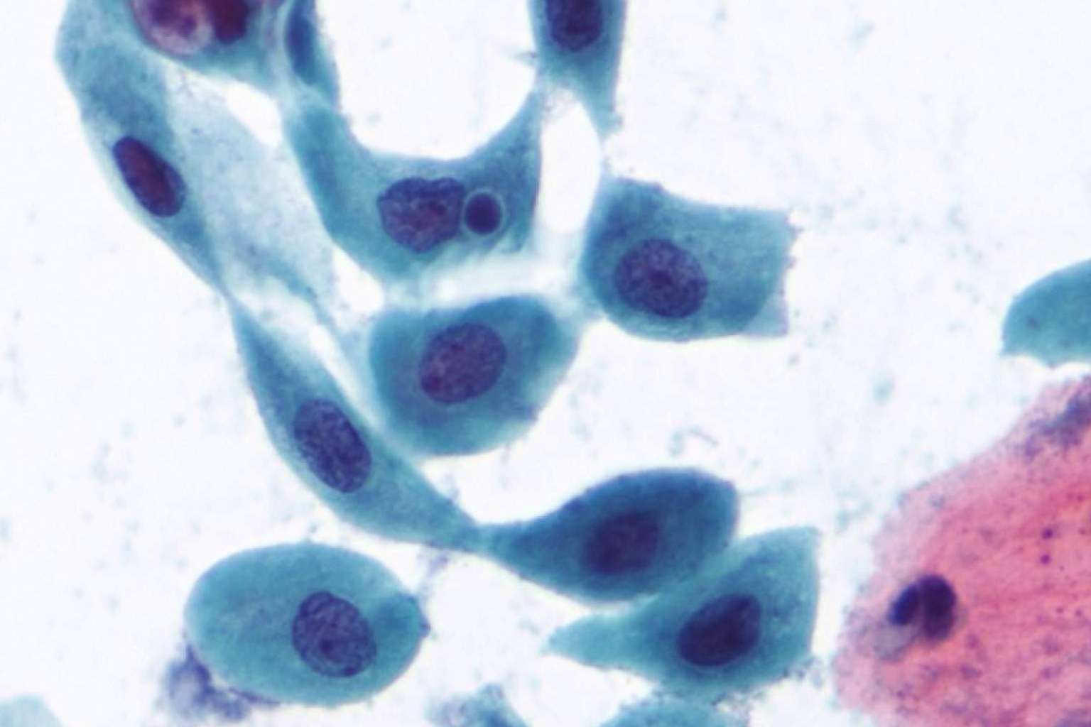 CITOMOL ofrece soluciones avanzadas para la determinación del virus del papiloma humano en varones