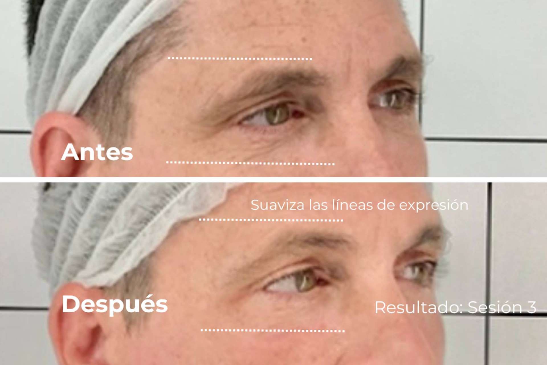 Novedad mundial; Lifting 4D llega para transformar el rejuvenecimiento facial sin procedimientos invasivos