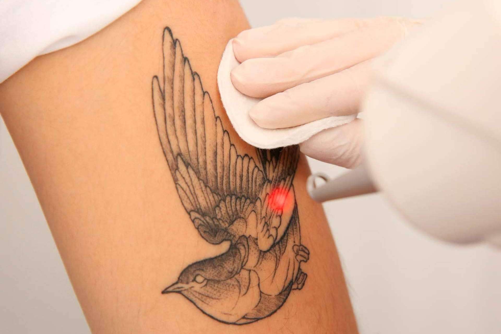 Eliminación de tatuajes con picolaser, la tecnología avanzada en despigmentación llega a 360Clinics
