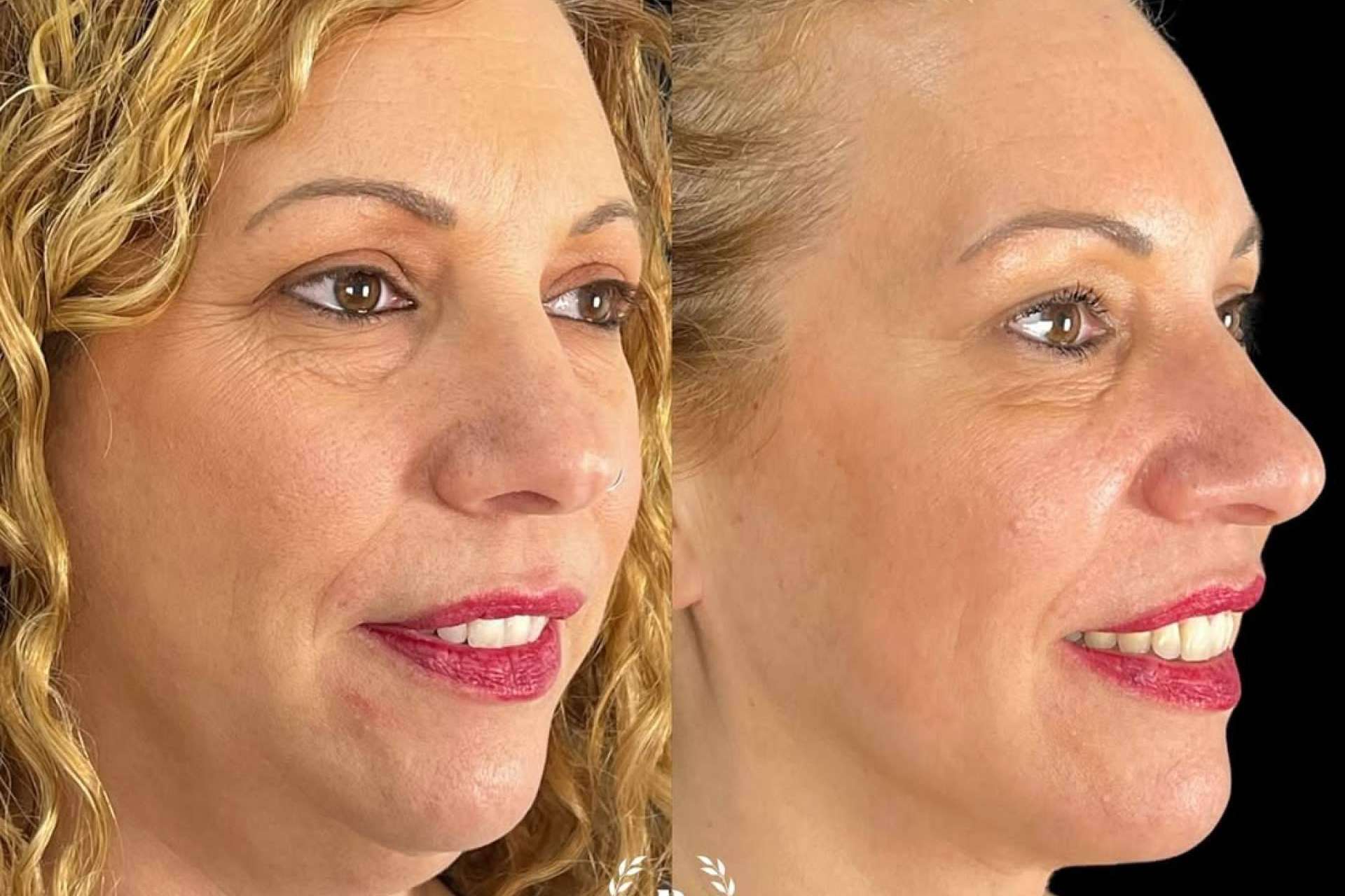 Descubrir la lipopapada en Clínica Roma
