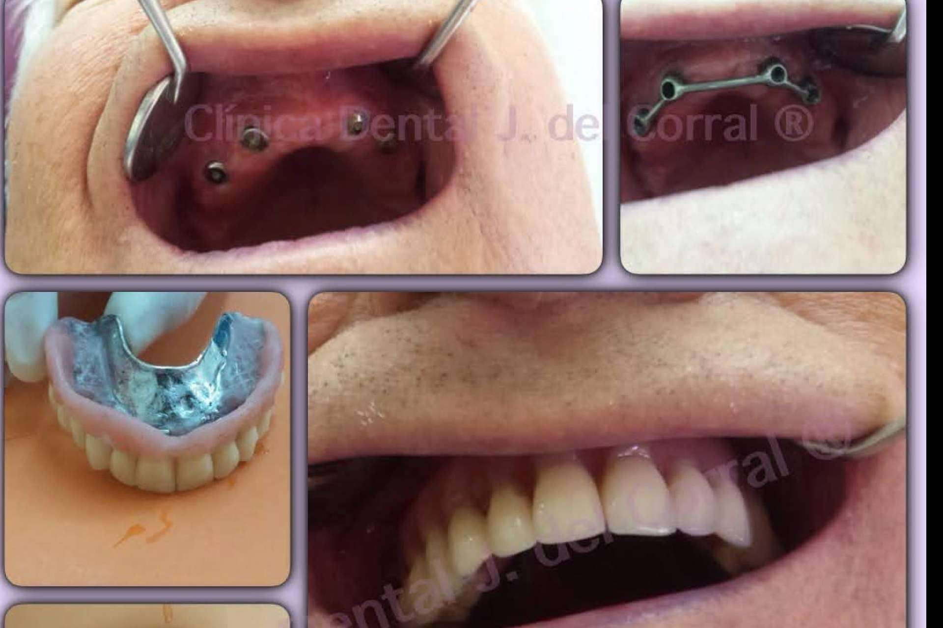 Estética dental de vanguardia con implantes, carillas, prótesis y ortodoncia en la Clínica Dental Jorge del Corral