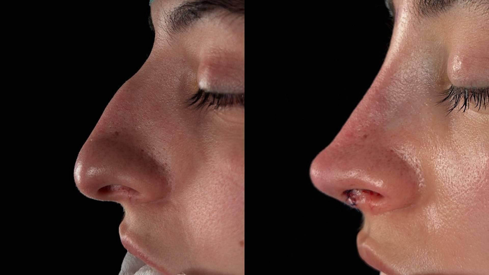 Más allá del quirófano, el miedo a una rinoplastia y la pérdida de identidad facial